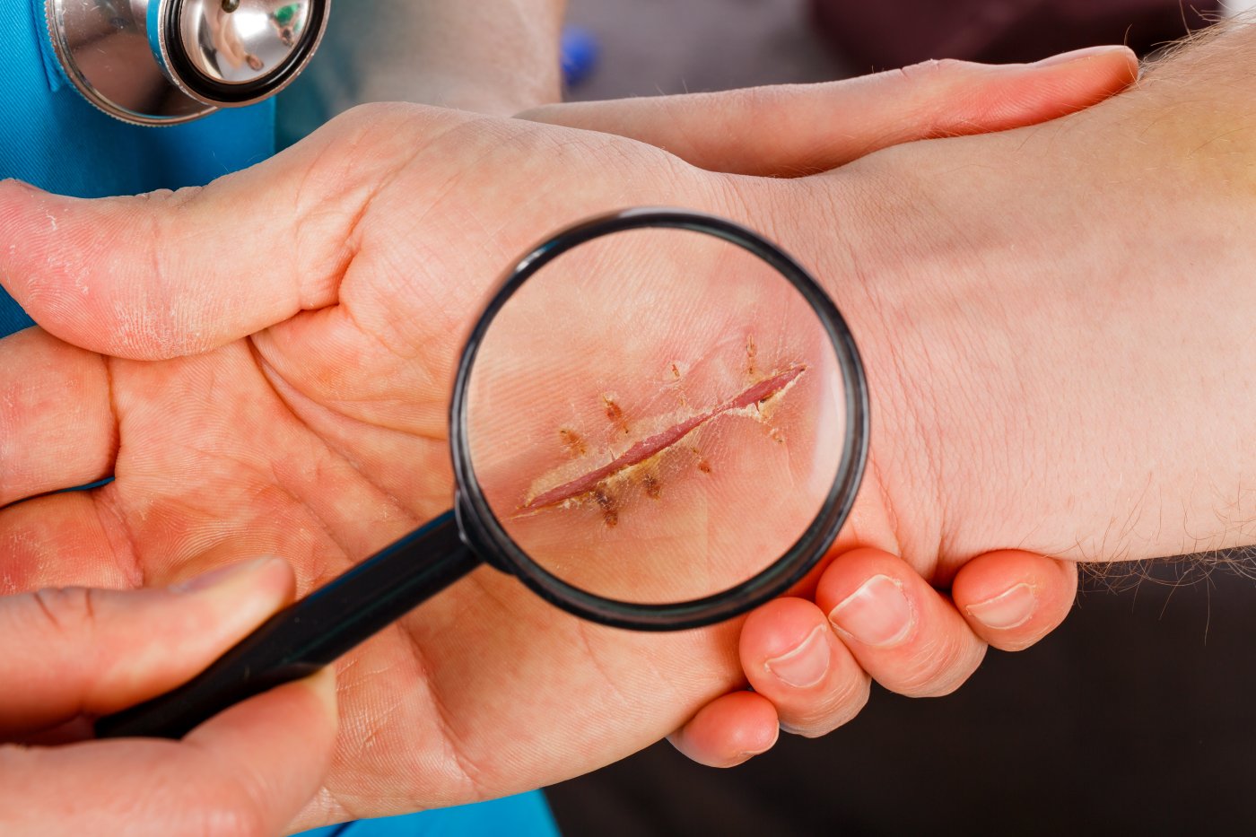 Badanie dłoni pod lupą — diagnostyka zespołu cieśni nadgarstka