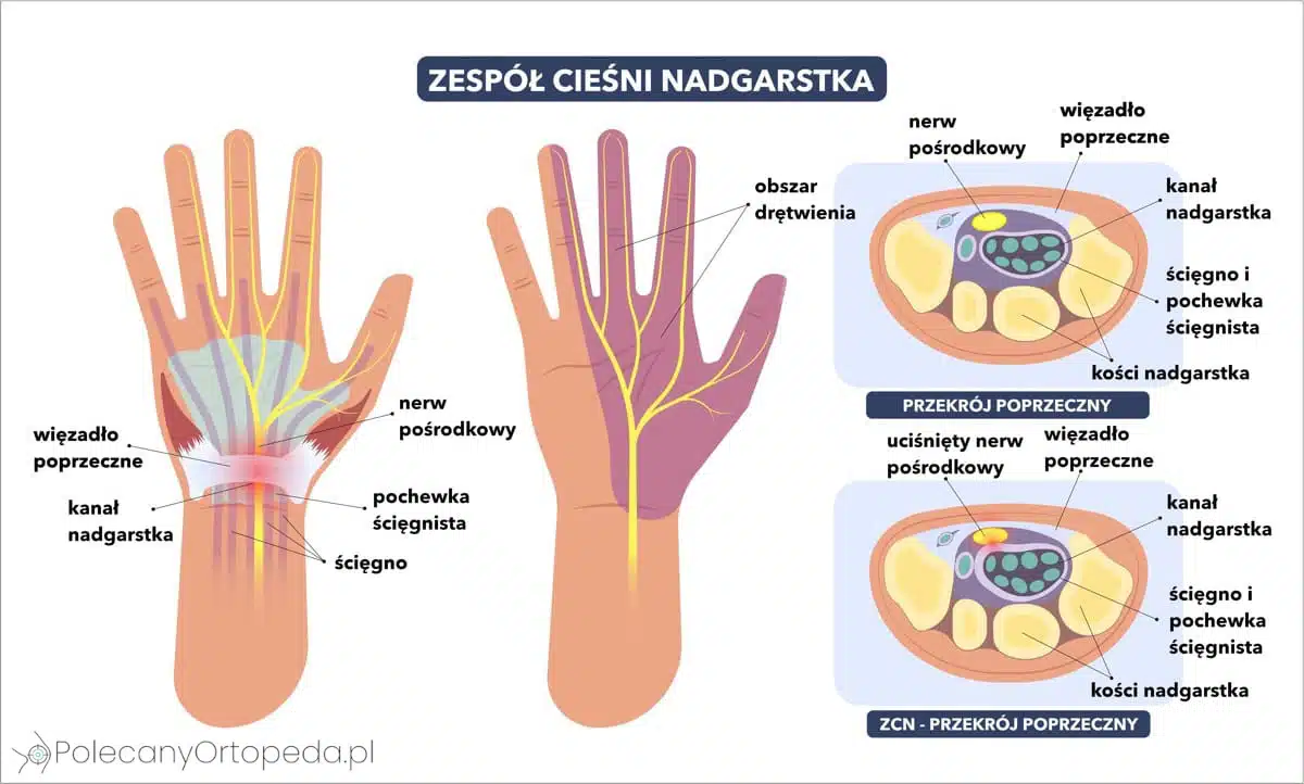 Schemat anatomiczny zespołu cieśni nadgarstka — nerw pośrodkowy, więzadło poprzeczne i przekrój kanału